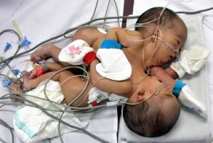 INDONESIA-HEALTH-CONJOIN-TWINS